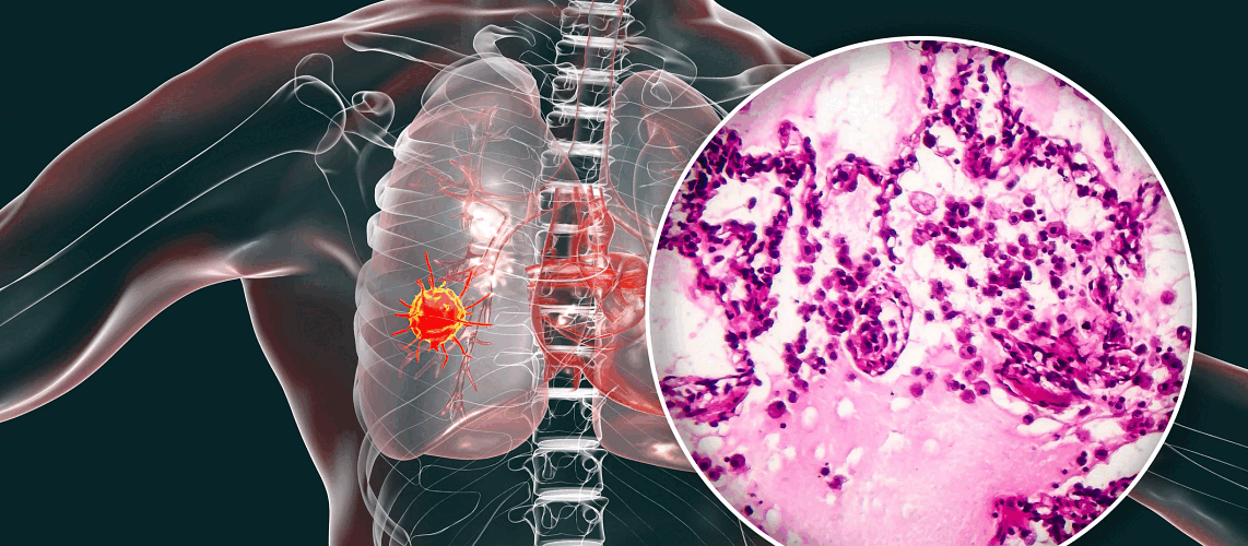 Targeting serine/glycine metabolism with sertraline can enhance radiotherapy responses in NSCLC - ESTRO 2 What is Non-Small Cell Lung Cancer? | Charles River