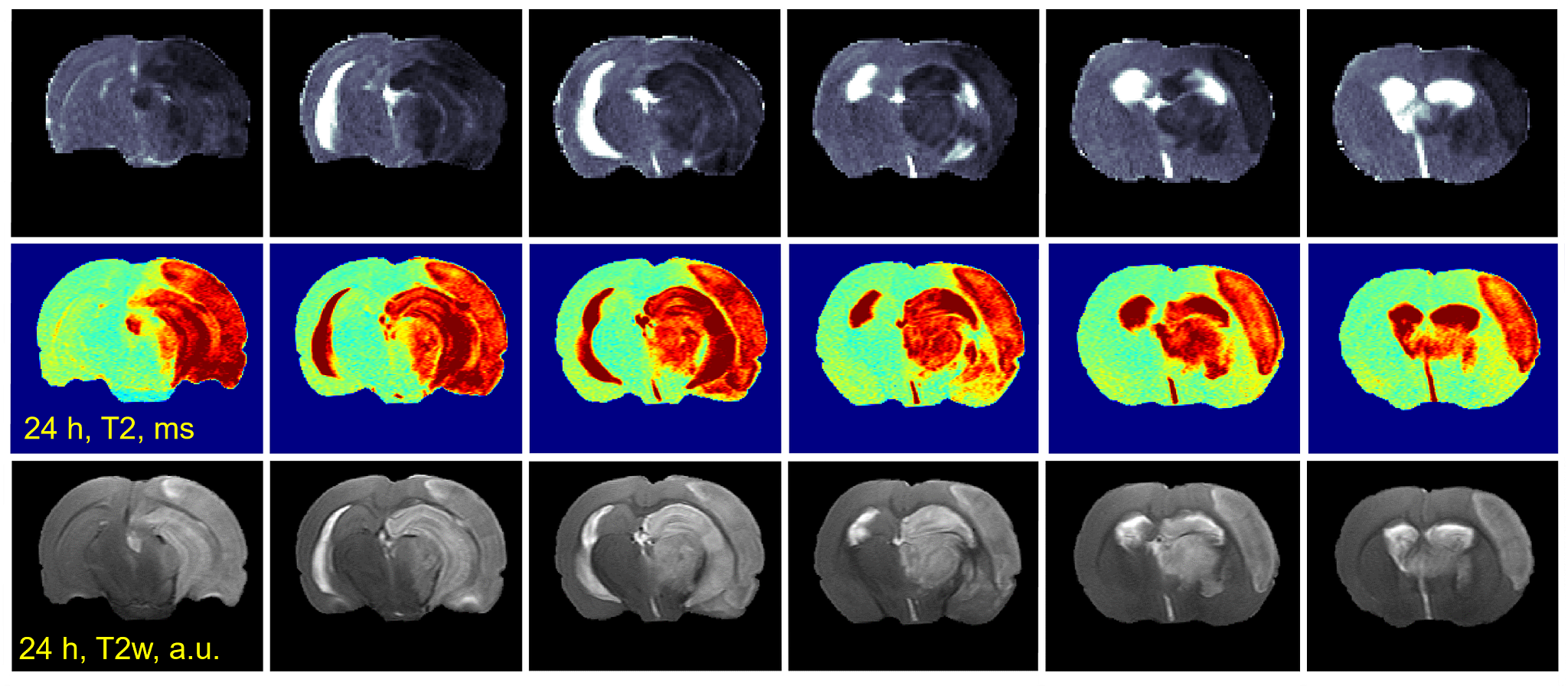 MRI images showing  early detection of ischemia by diffusion weighted MRI 30 minutes post-surgery (top row), analysis of tissue viability by quantitative T2 relaxometry at 24 hours post-surgery (middle row), and analysis of lesion volume and edema by high resolution T2-weighted imaging 24 hours post-surgery (bottom row).