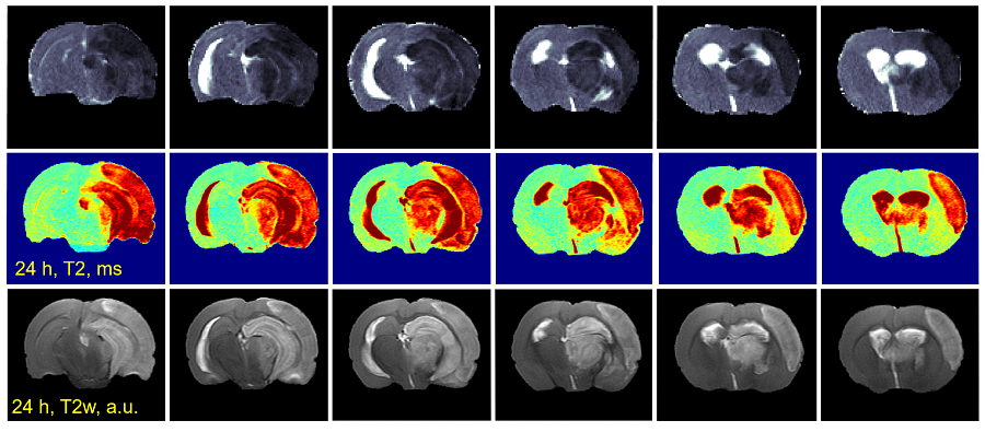 MRI images showing early detection of ischemia by diffusion weighted MRI 30 minutes post-surgery (top row), analysis of tissue viability by quantitative T2 relaxometry at 24 hours post-surgery (middle row), and analysis of lesion volume and edema by high resolution T2-weighted imaging 24 hours post-surgery (bottom row).