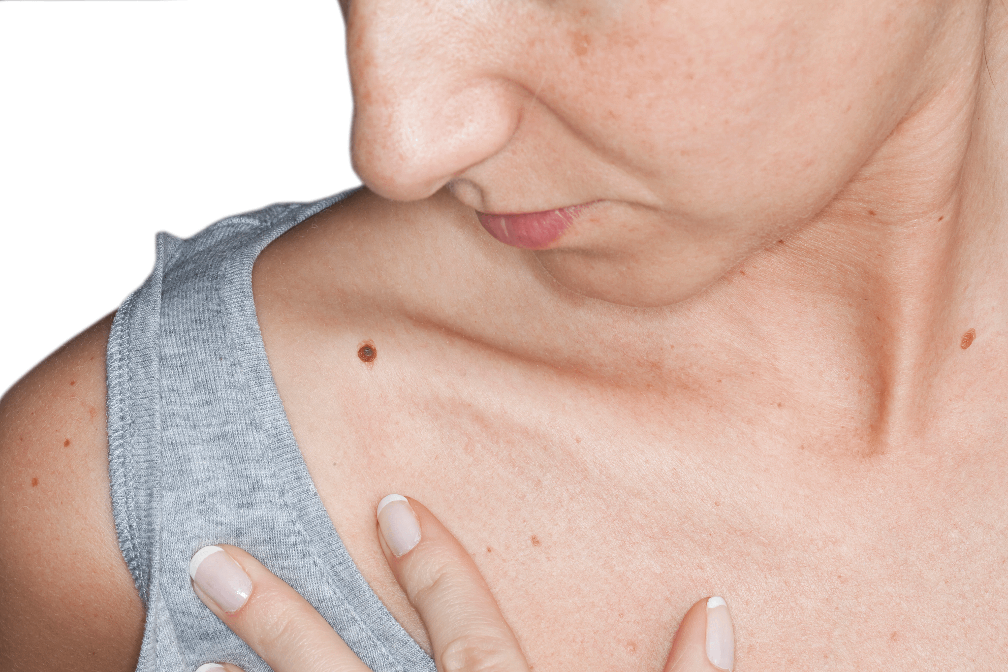 Person looking at Melanoma on skin