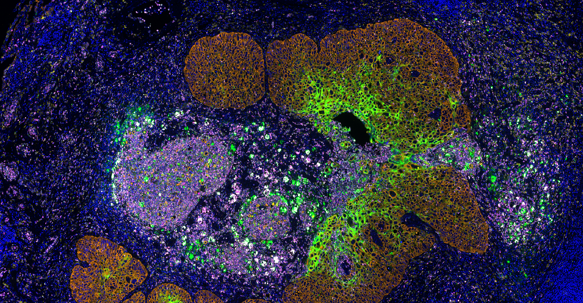 lung cancer with inflammation