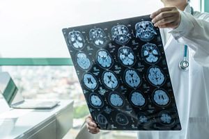 medical doctor holding up Magnetic Resonance Imaging (MRI) film diagnosing neurodegenerative