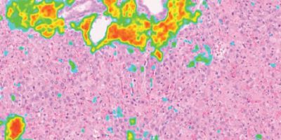 Digitally analyzed histology slide displaying a pink tissue background with multicolor heatmap overlays and a corresponding color scale beneath it.