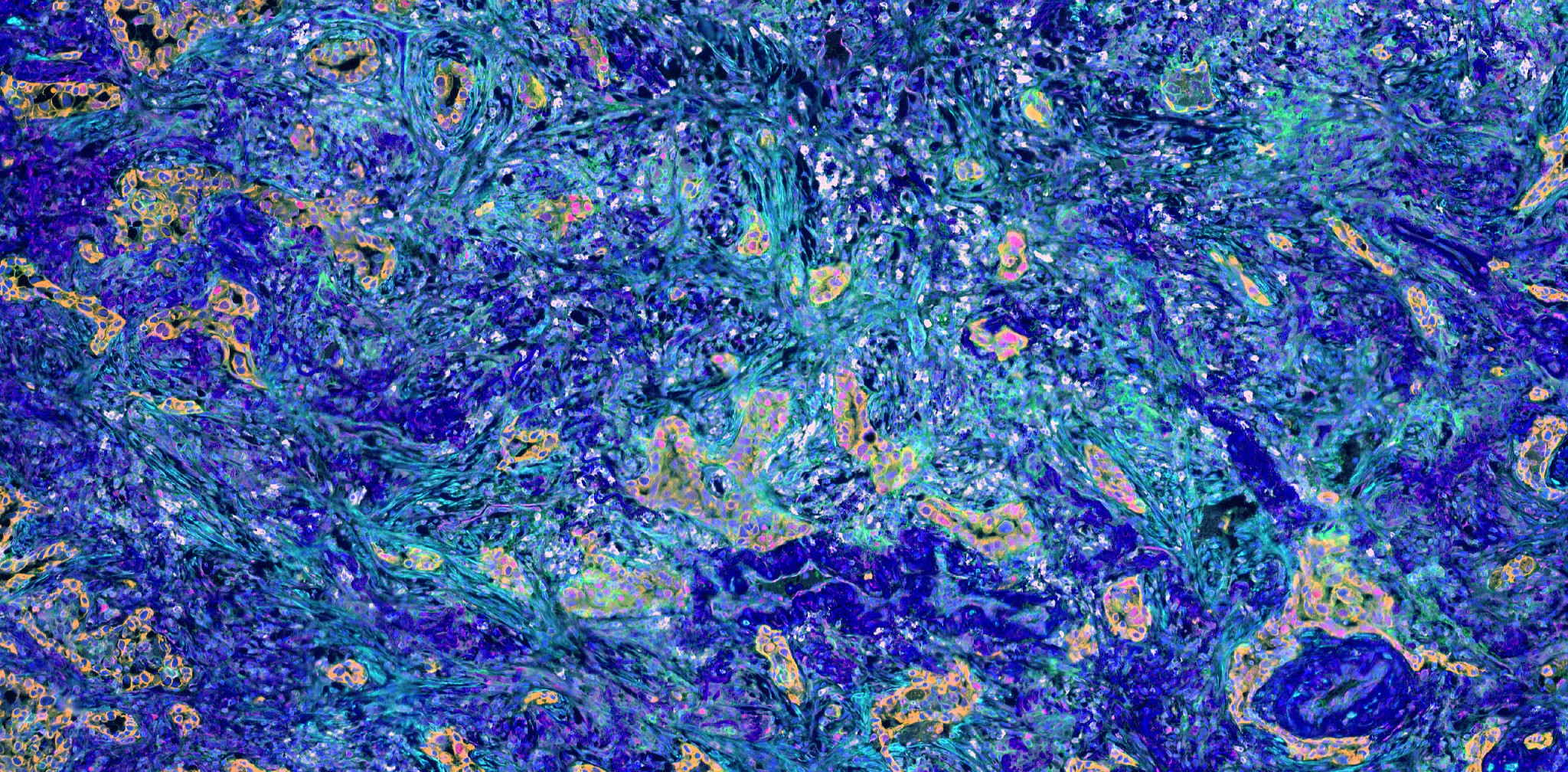 Pathology slide of Lung carcinoma.jpeg
