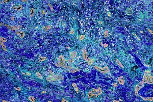 Pathology slide of Lung carcinoma.jpeg