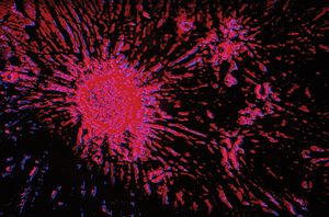 microscopic image of breast cancer
