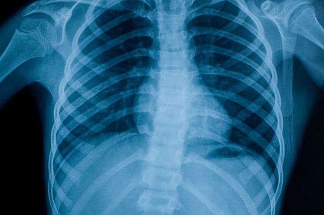 X-ray image of chest