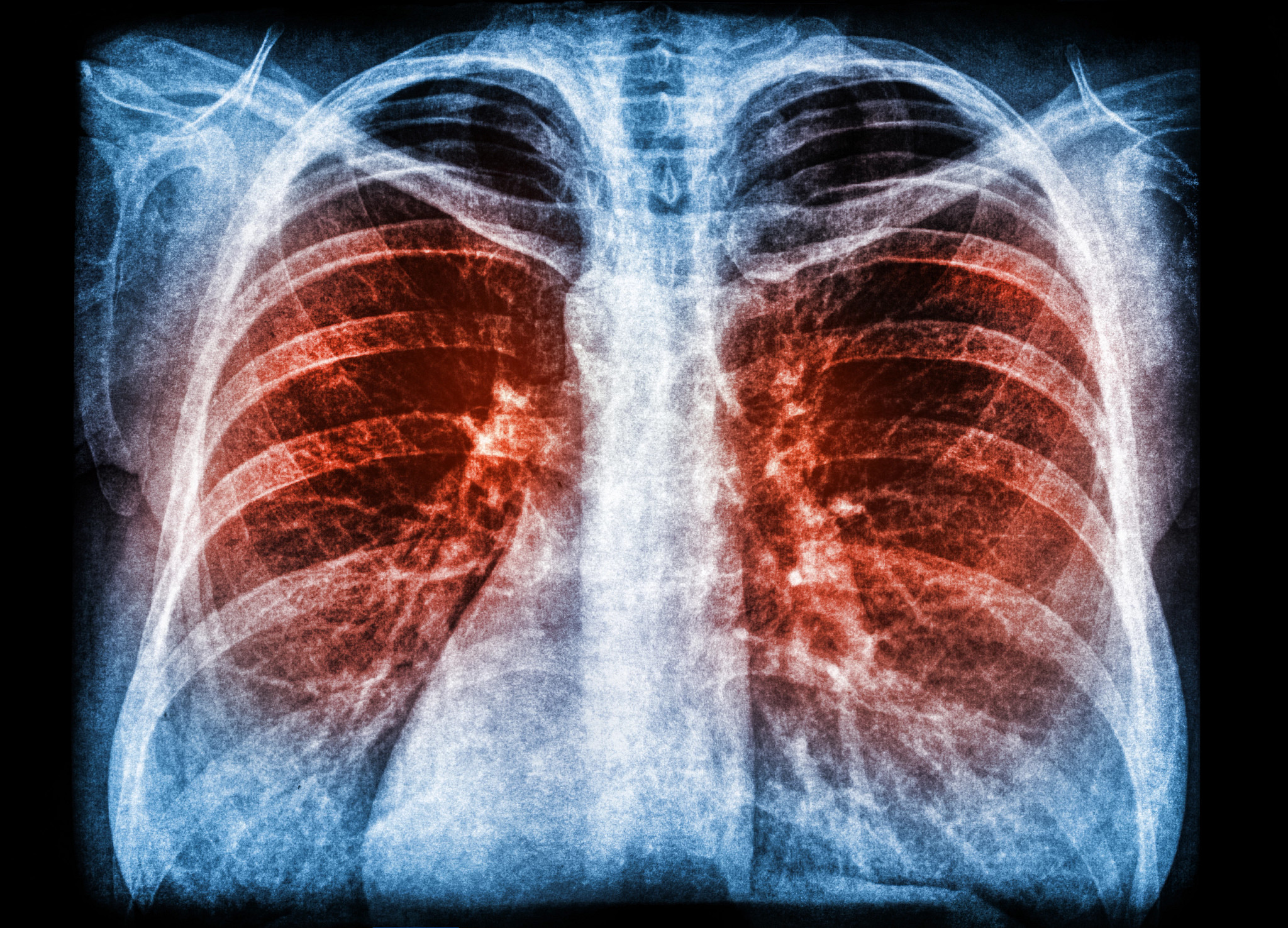 X-ray image of human lung