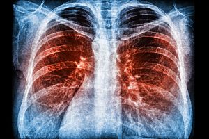 X-ray image of human lung