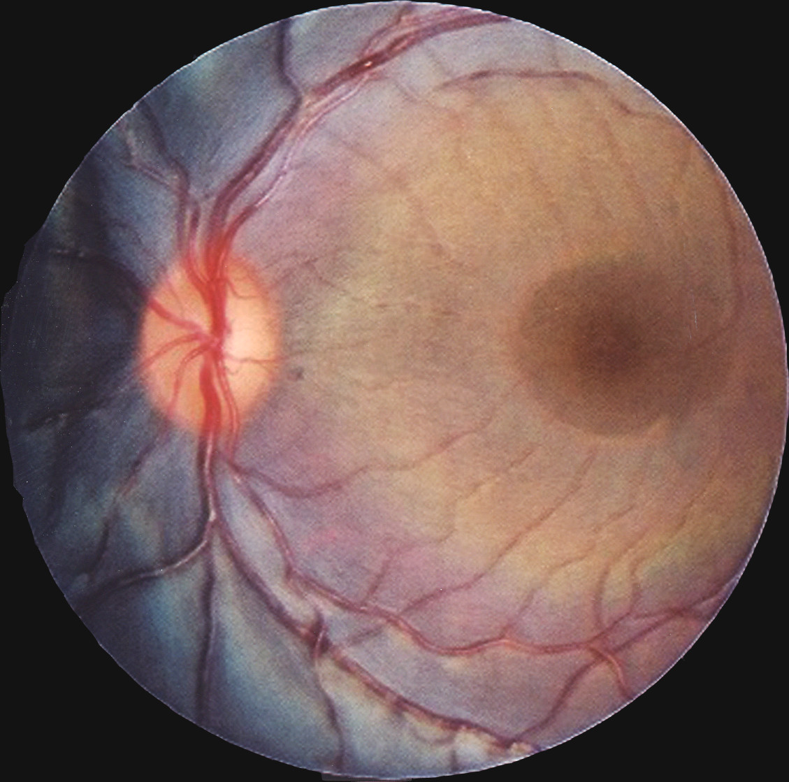Photo showing the back of a large animal’s eye, highlighting the dark reddish choroidal neovascularization.