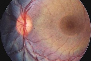 Photo showing the back of a large animal’s eye, highlighting the dark reddish choroidal neovascularization.