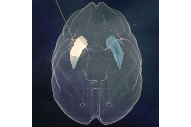 A computer graphic image of a top view of a probe delivering an AAV-packaged gene to the mid-brain.