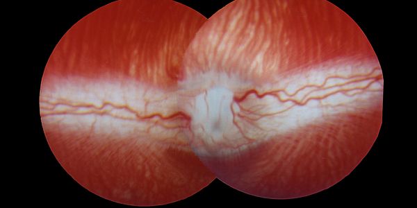 Photo showing the back of a large animal eyes, highlighting the dark reddish choroidal neovascularization.