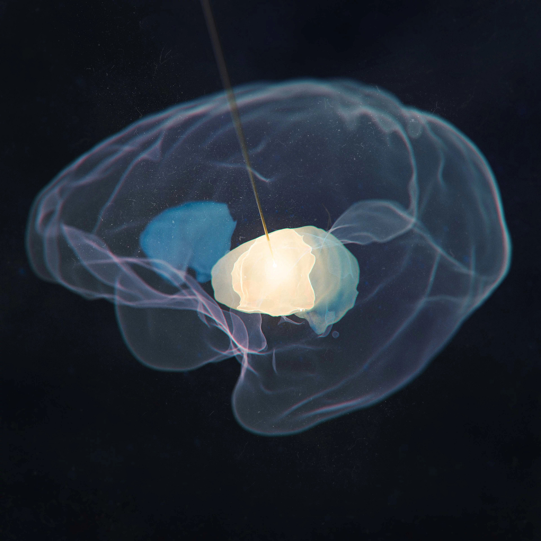 a rendering of MRI-guided delivery for gene therapies