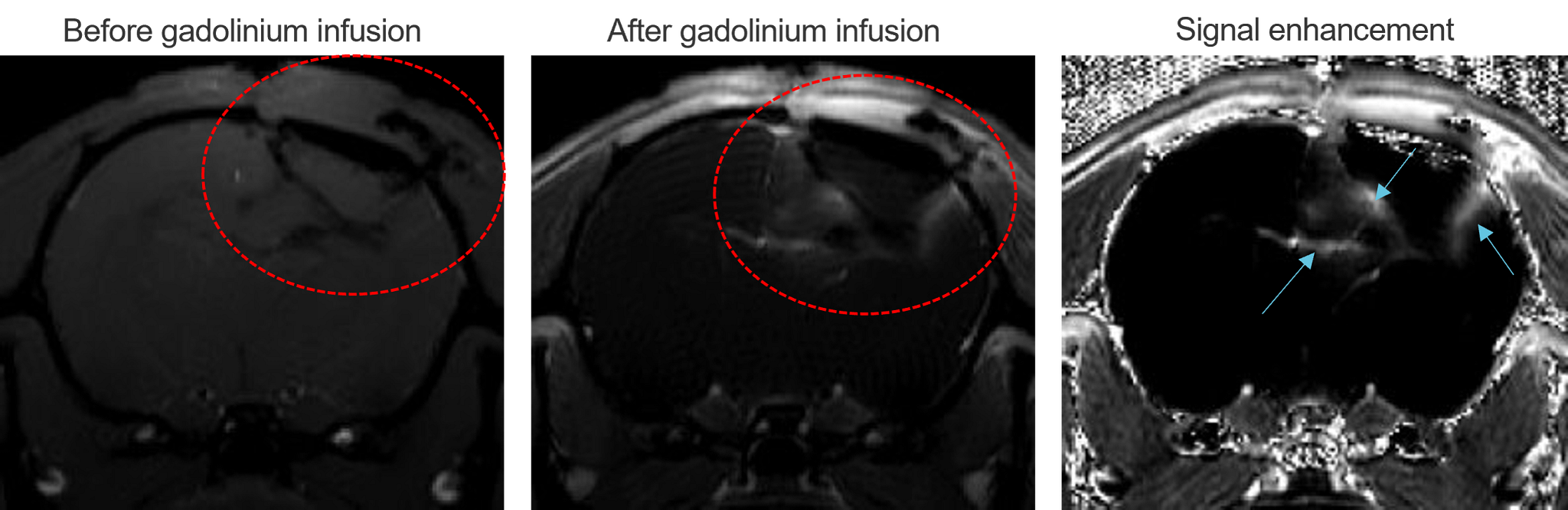 Example MRI images before and after gadolinium contrast injection